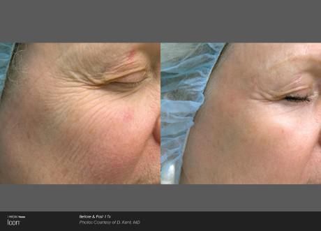 Before and after comparison of a person's eye area showing a reduction in fine lines and wrinkles after skin treatment.