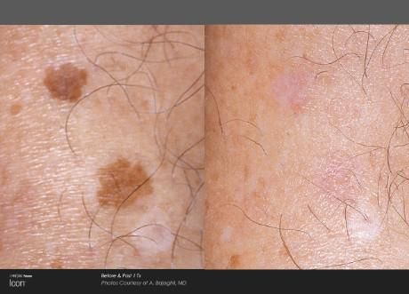 Before-and-after photos of a skin lesion treated with laser therapy, showing the spot present then resolved.