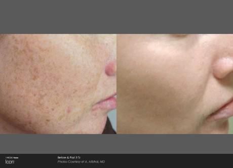 Before and after comparison of skin showing a significant reduction in dark spots and pigmentation after treatment.