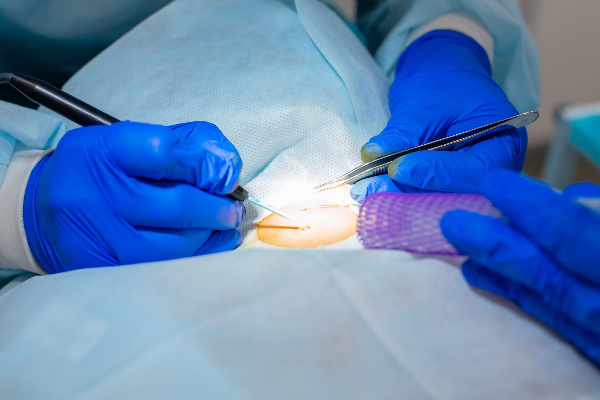 Medical professionals in blue gloves performing a procedure on a patient's skin using surgical tools.