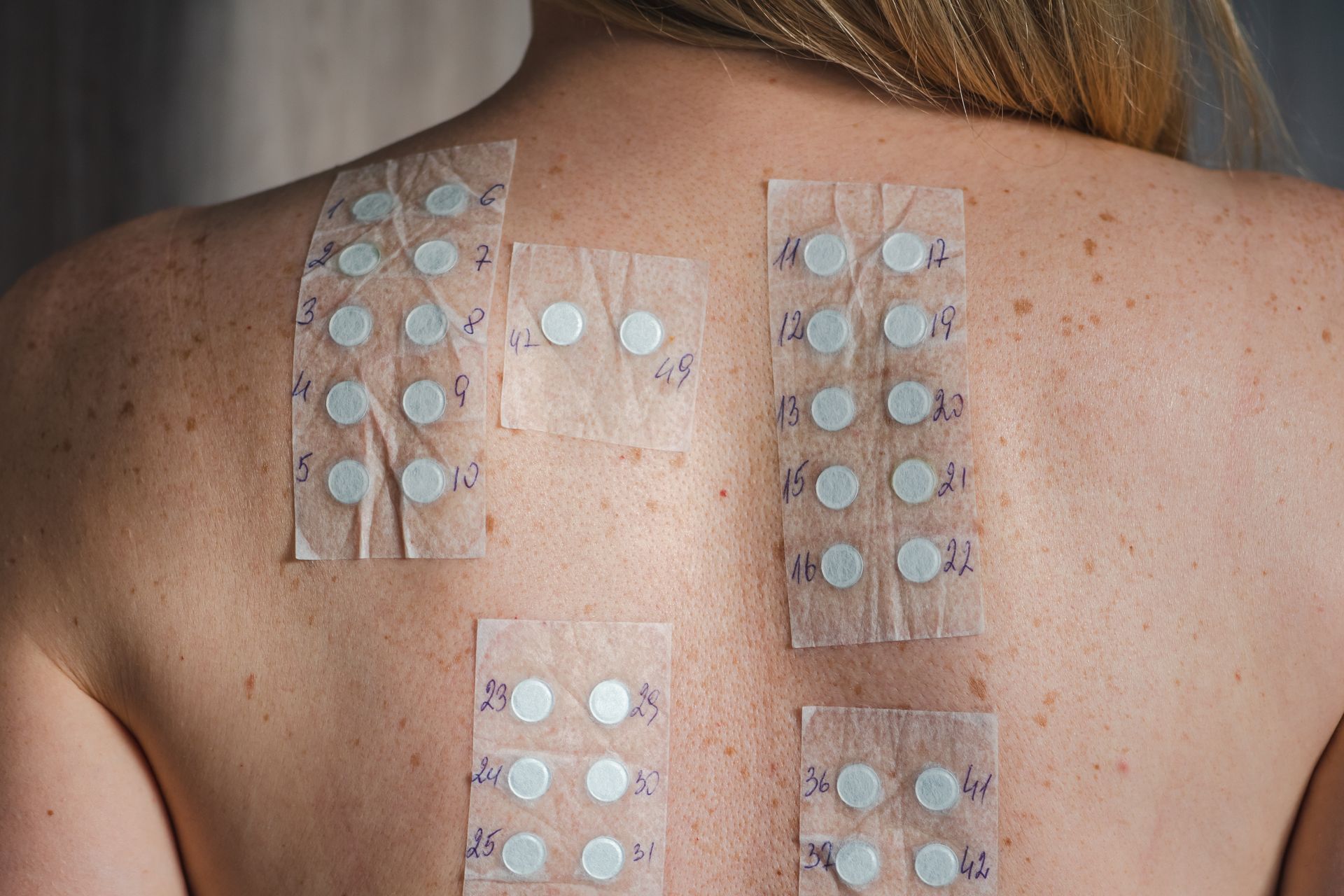 A person's back with multiple numbered adhesive patches applied to the skin for an allergy patch test.