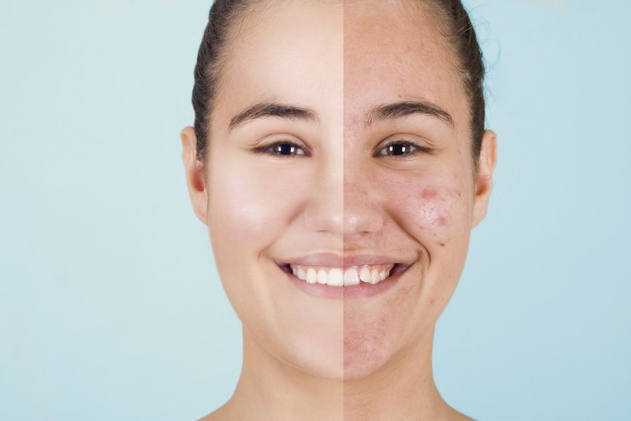 A split-screen comparison of a face showing clear, smooth skin on the left and blemish-prone, textured skin on the right.