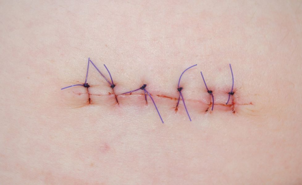 A surgical incision closed with six blue sutures on pale skin.