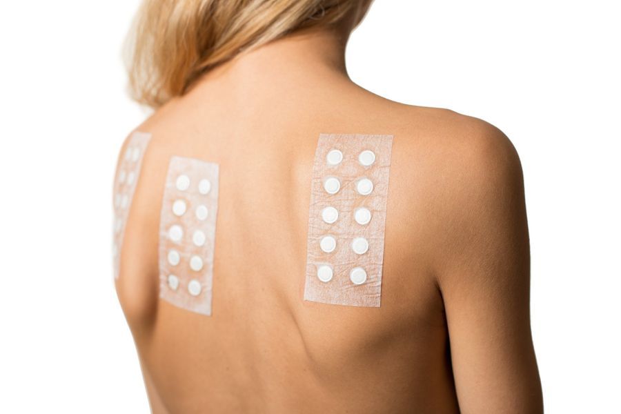 A person with allergy patch tests applied to their upper back.