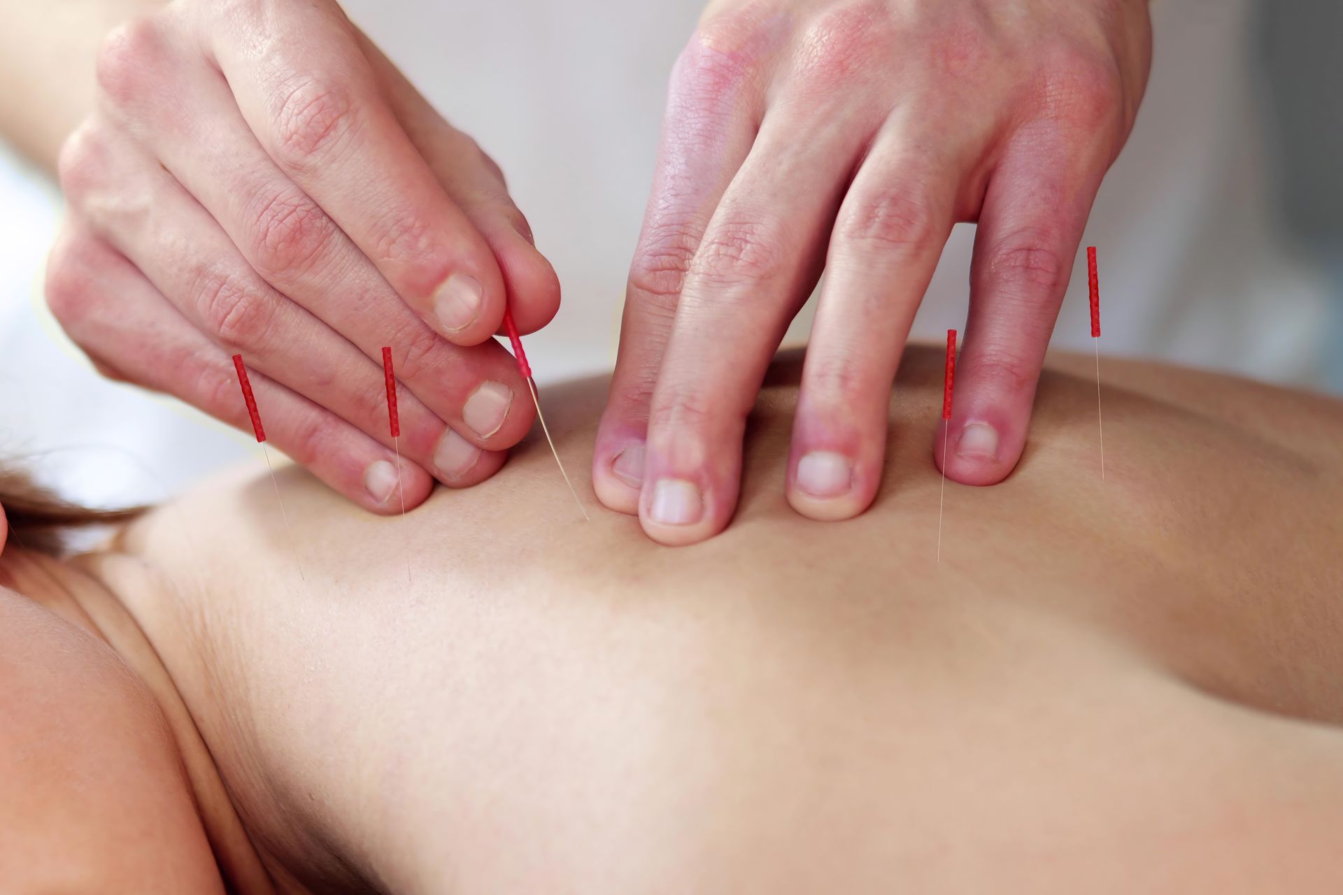 A person is getting acupuncture on their back.