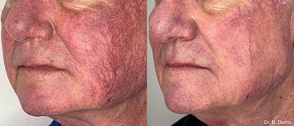 A before and after photo of a man 's face with red veins.