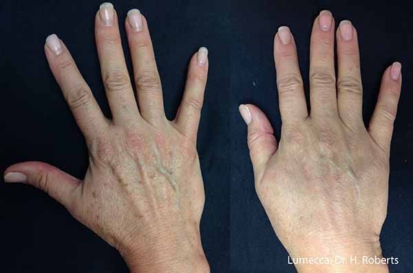A close up of a woman 's hands with white nails on a black background.