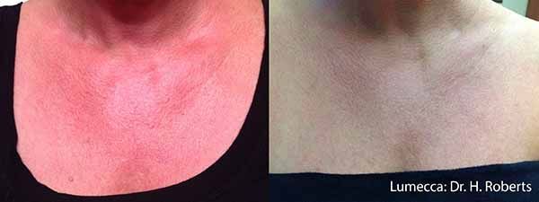 A before and after photo of a woman 's neck and chest.