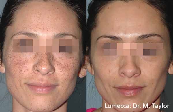 A before and after photo of a woman 's face by dr. m. taylor