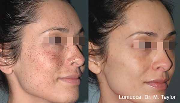 A before and after photo of a woman 's face.