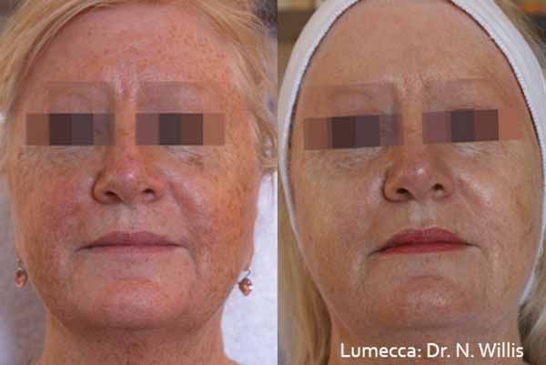 A before and after photo of a woman 's face by dr. n. willis