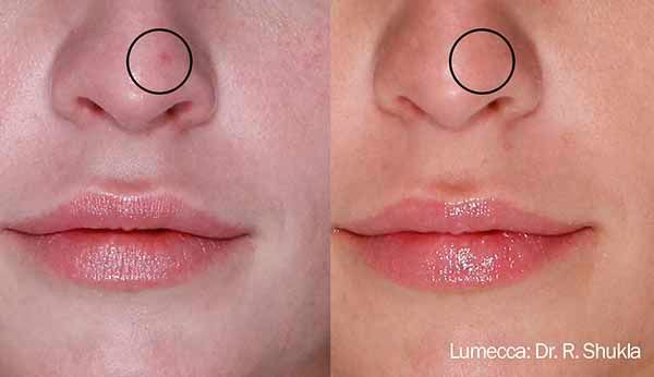 A before and after photo of a woman 's nose and lips.