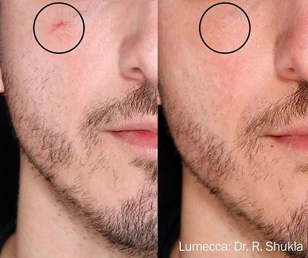 A before and after photo of a man 's face