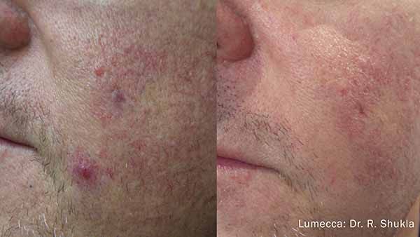 A before and after photo of a man 's face with acne.