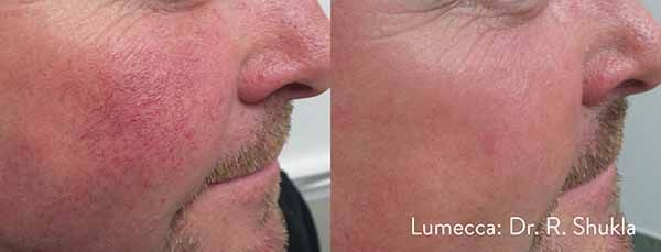A before and after photo of a man 's face with red veins.