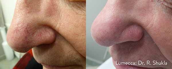 A before and after photo of a woman 's nose