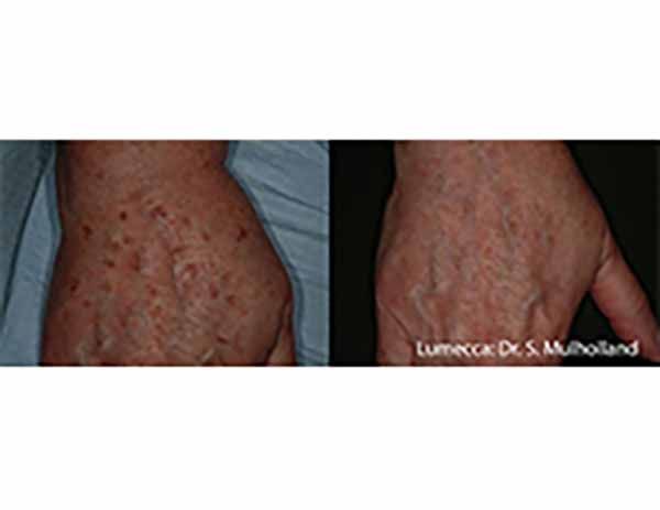 A before and after photo of a person 's hand.