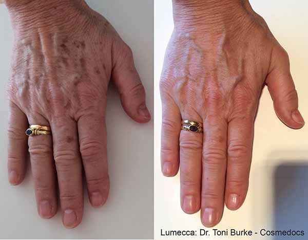 A before and after photo of a woman 's hand with a ring.