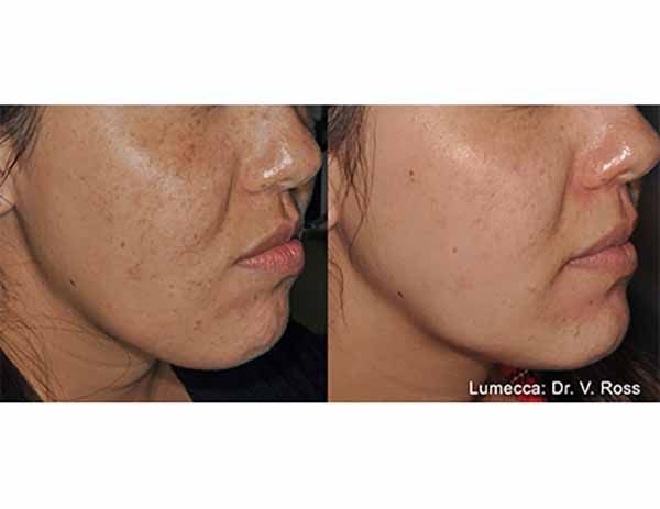 A before and after photo of a woman 's face.