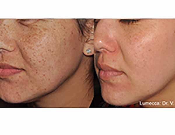 A before and after photo of a woman 's face with freckles.