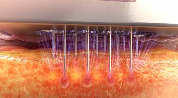 A close up of a person 's skin with needles coming out of it.