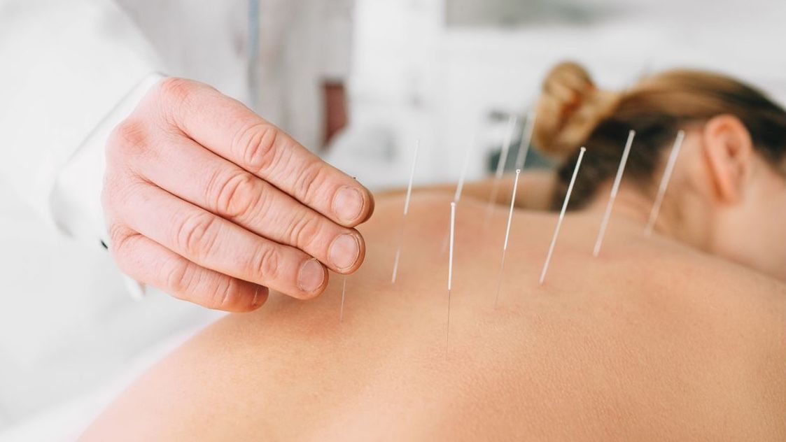 A Patient receives acupuncture treatment