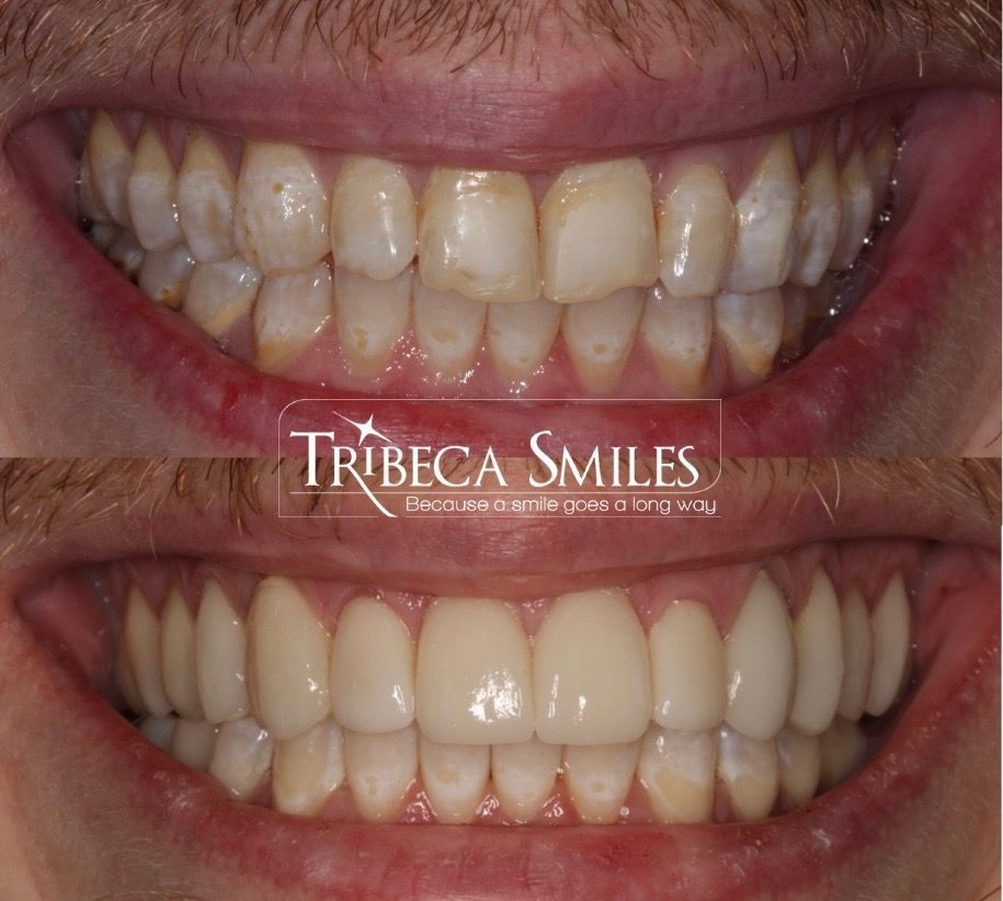 A  before and after photo of cosmetic porcelan veeneers in Tribeca Smiles, NYC