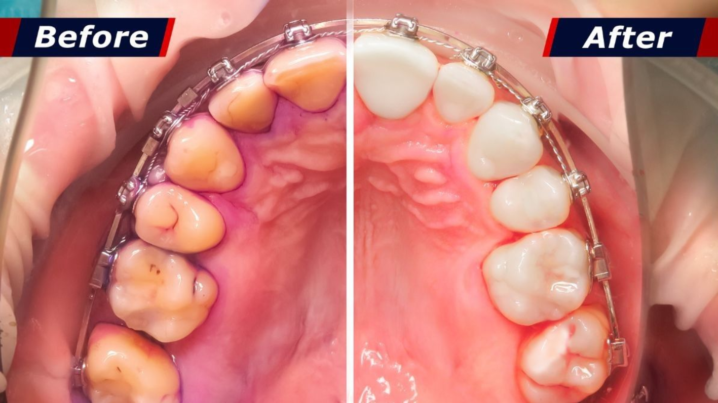 Before and After tartat cleaning photo