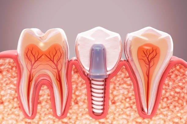 Dental Implants