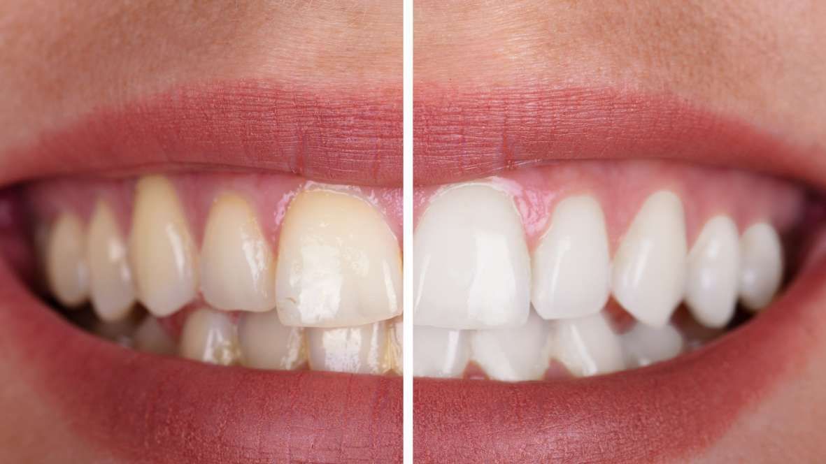 A close-up comparison of teeth before and after professional cleaning,