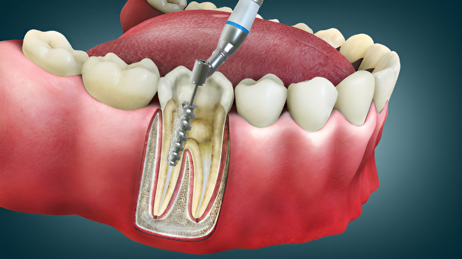 Root canal therapy