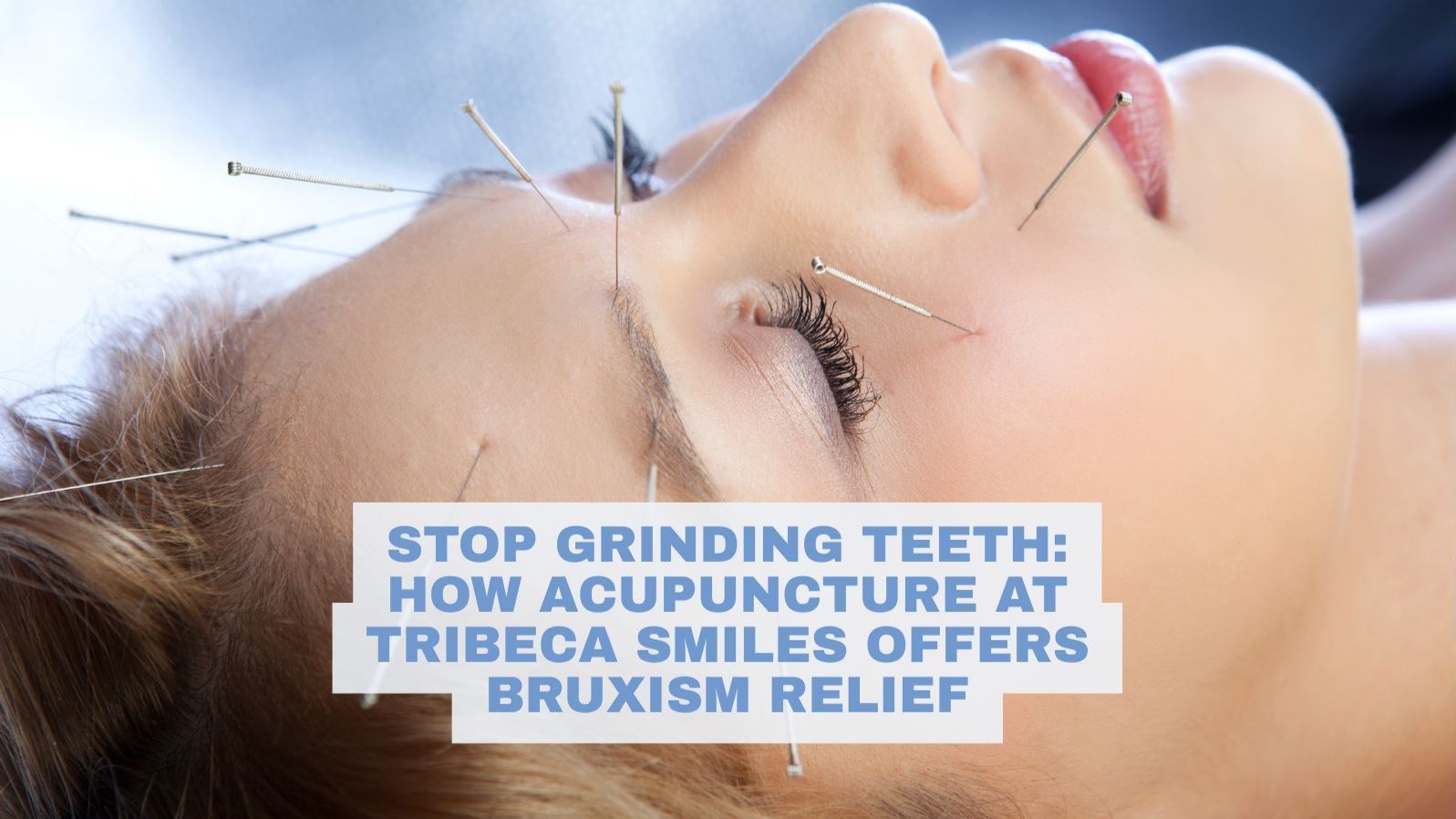 Patient receives acupuncture treatment for grinding teeth bruxism at Tribeca Smiles