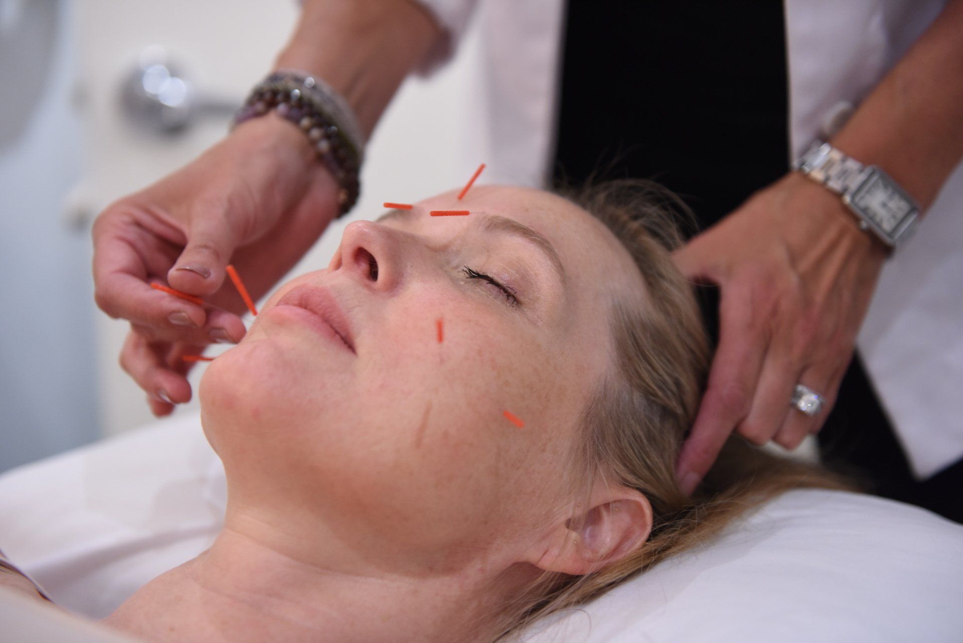 Acupuncture Service on Patient