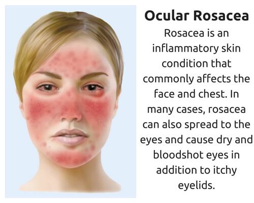 drawing of a woman with ocular rosacea