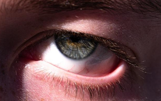 Recognizing and Treating Summer Conjunctivitis (Pink Eye) | Baptist Eye Recognizing and Treating Summer Conjunctivitis (Pink Eye) | Baptist Eye