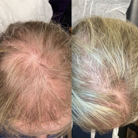 A before and after photo of a man's hair growth after PRP Treatment in San Diego.