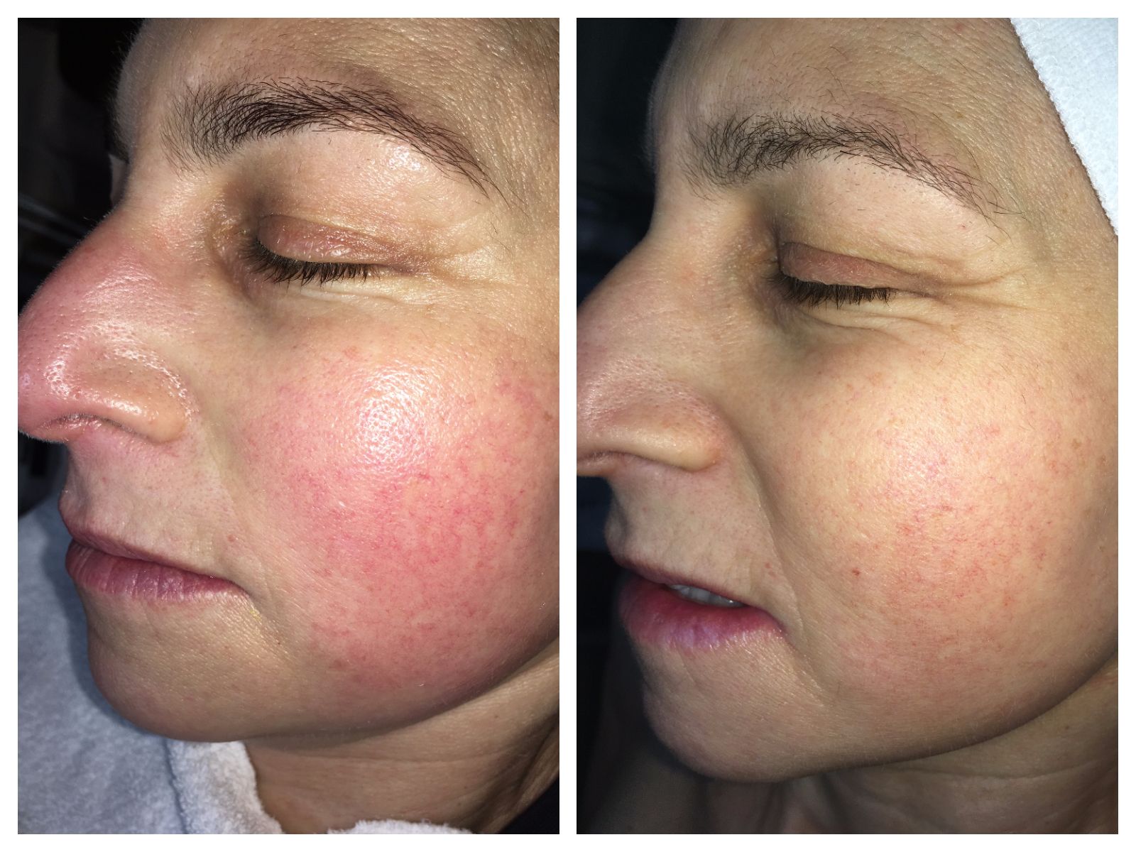 A woman 's face is shown before and after a treatment.