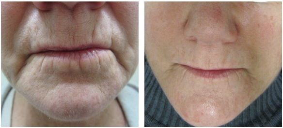 A before and after photo of a woman 's face