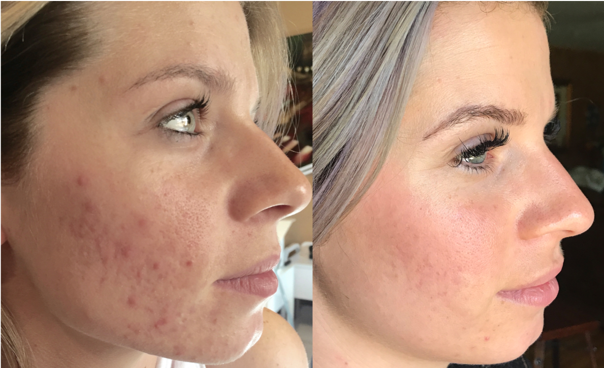 A before and after photo of a woman 's face with acne and without acne.