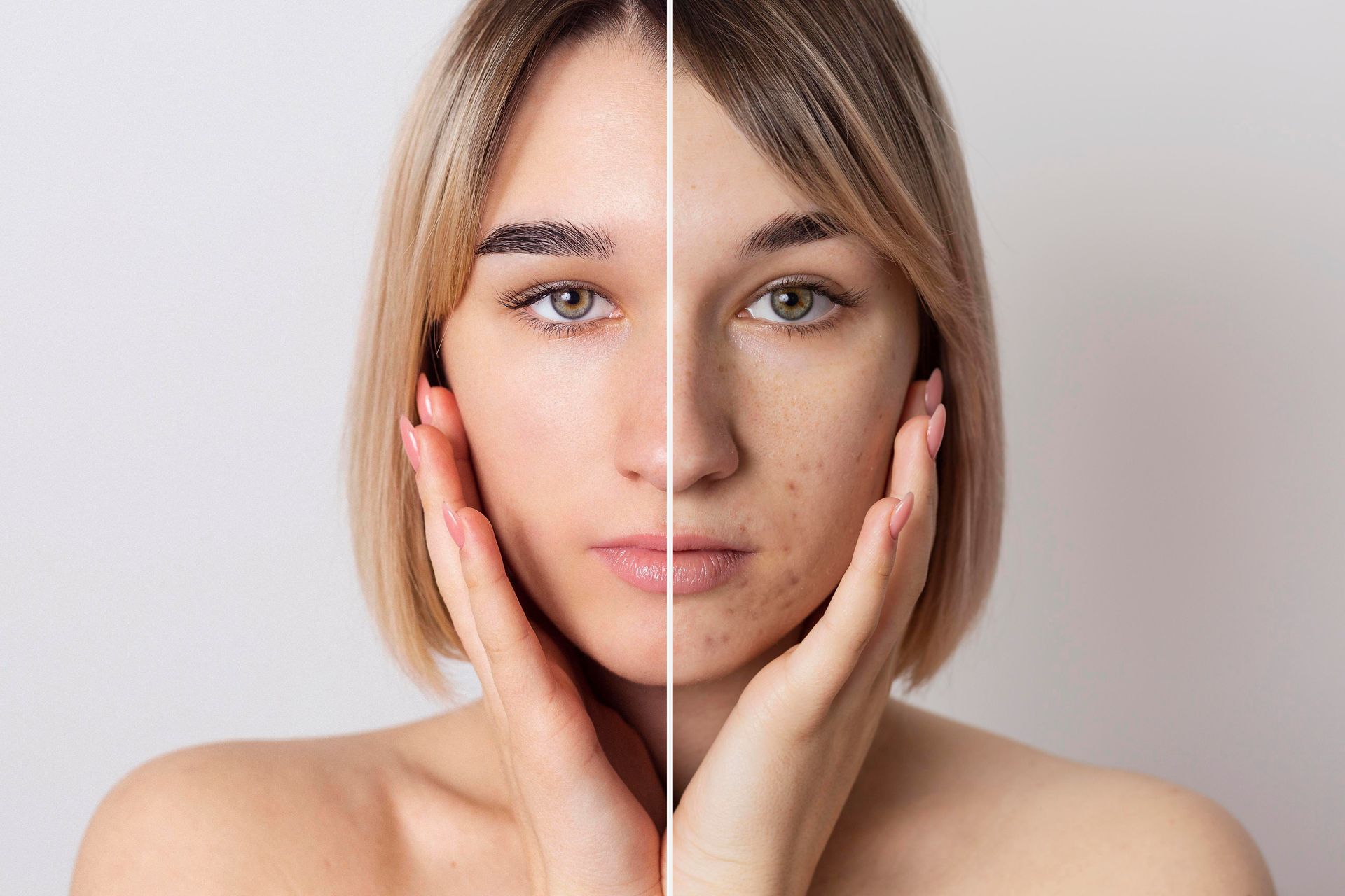 A split-screen comparison showing a face with smooth skin on the left and acne-prone skin on the right.