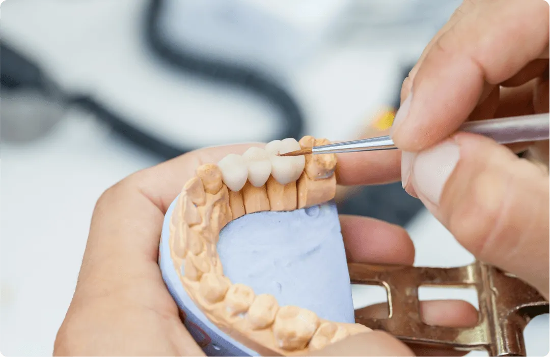 A model of a dental bridge is being worked on by a dental lab technician