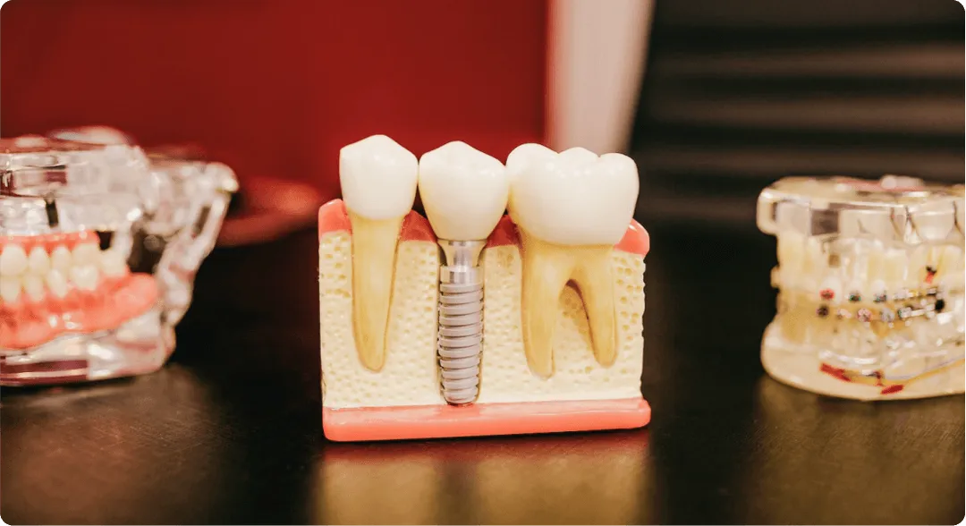 A model of a dental implant is sitting on a table next to other models of teeth