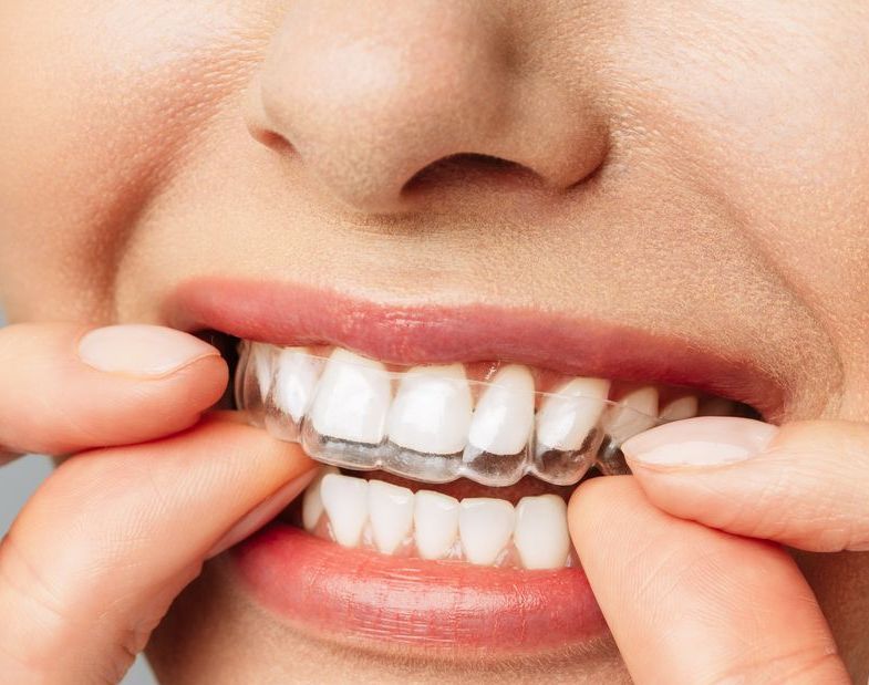 A woman is putting an Invisalign clear aligner on her teeth