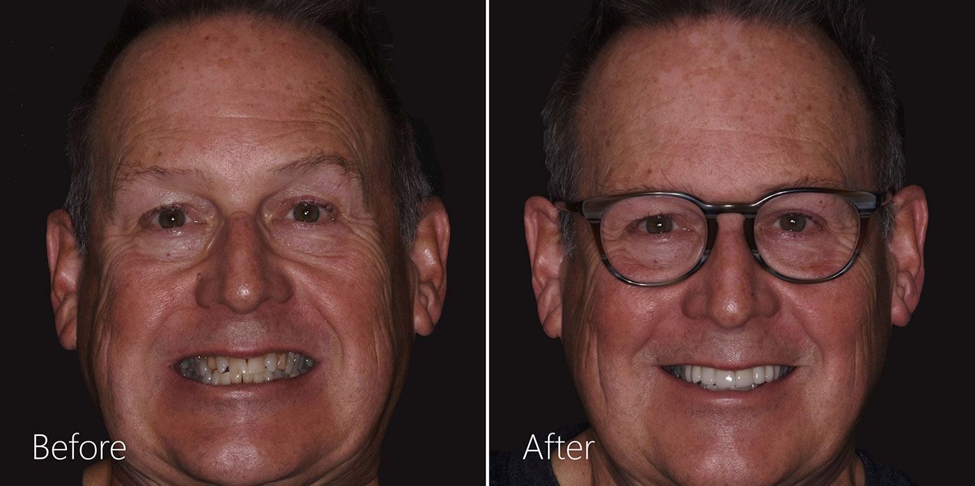 Before-After-Crowns-Dental