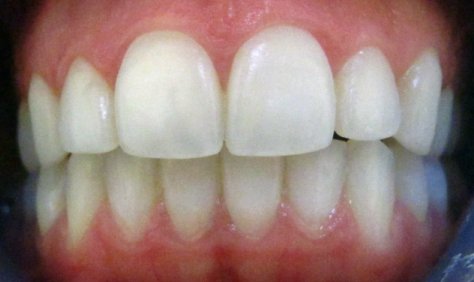 ICON Teeth Whitening Fort Collins