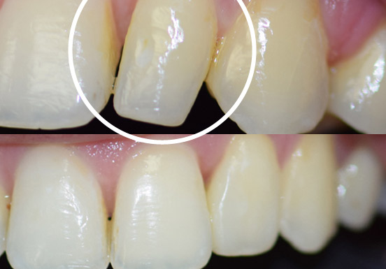 Peg Lateral Tooth Correction
