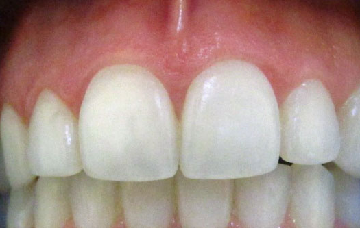 Teeth Whitening