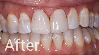 Composite Veneers Whitening
