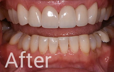 Dental Crowns