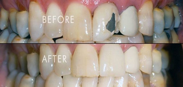 molar crown before after